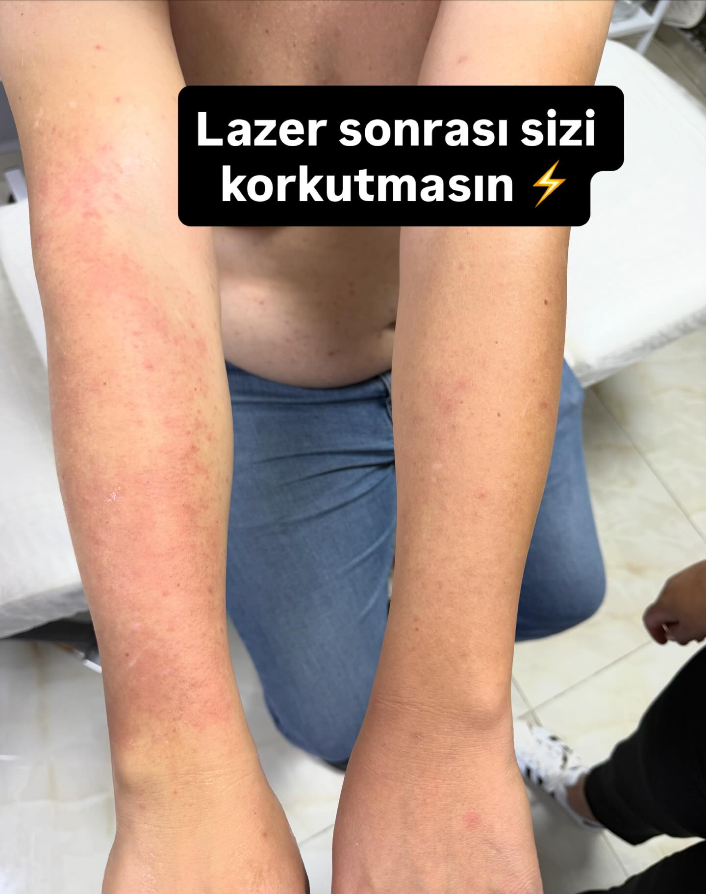 Lazer sonrası bakım önerileri 💧 Düzenli nemlendirme ve güneş koruyucu şart.